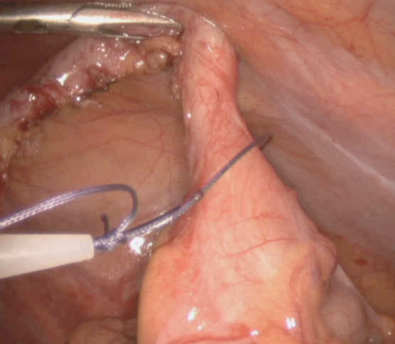 Appendicectomie - Bordeaux Chirurgie Viscérale et Digestive