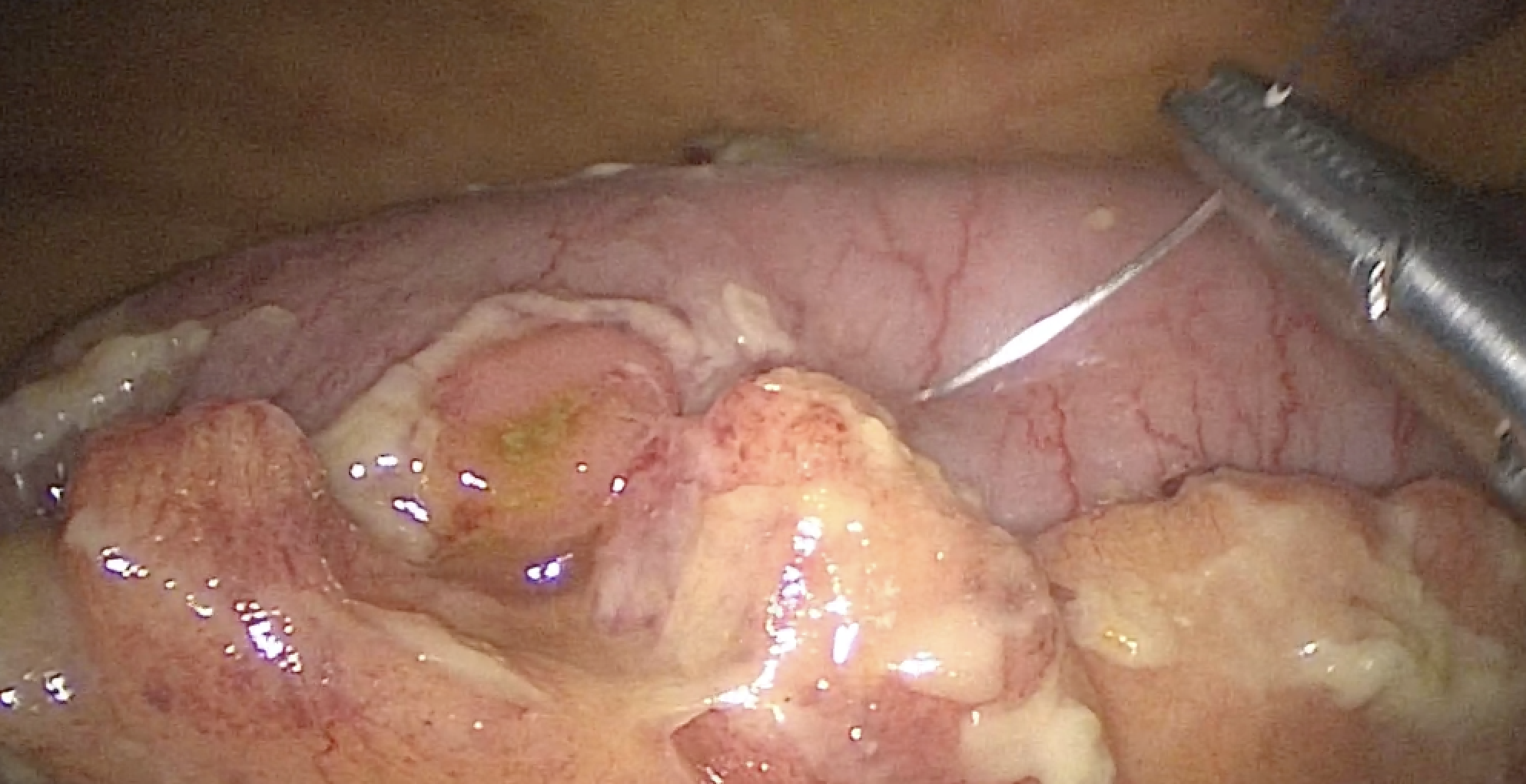 Ulcère gastro-duodénal - Bordeaux Chirurgie Viscérale et Digestive